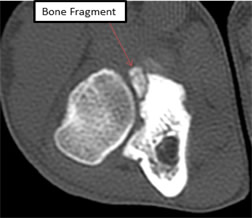 Elbow CT (computed tomography) scan